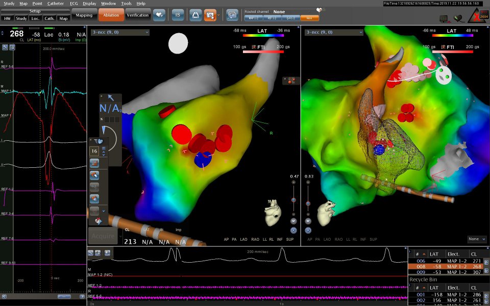 3 Boyutlu Haritalama Yöntemi ile Kateter Ablasyon